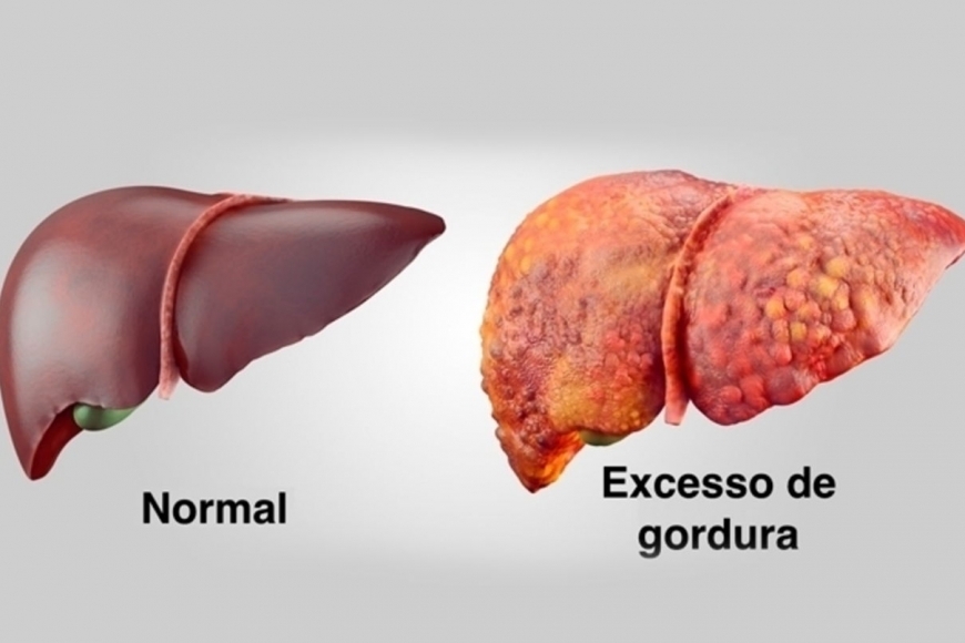 Esteatose Hepática: o que é? | Clínica Romanholi